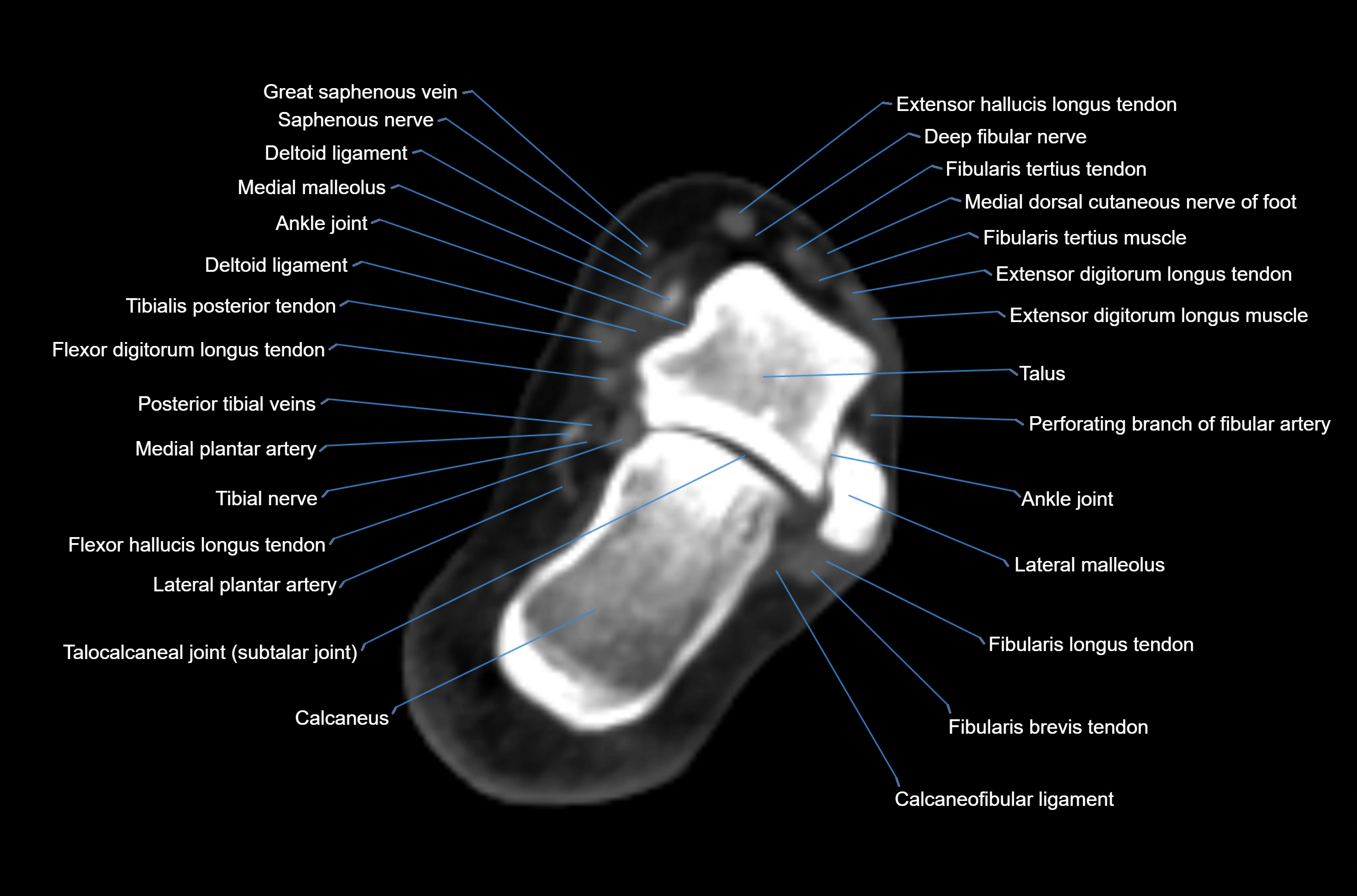 CT Ankle axial cross sectional anatomy labelled image -00034.webp